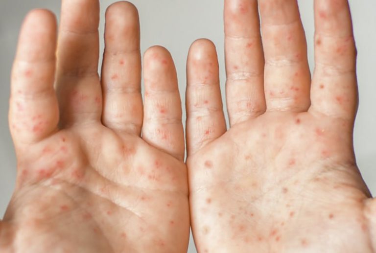 The number of measles cases is growing in Georgia January 2024